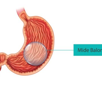 Mide Balonu