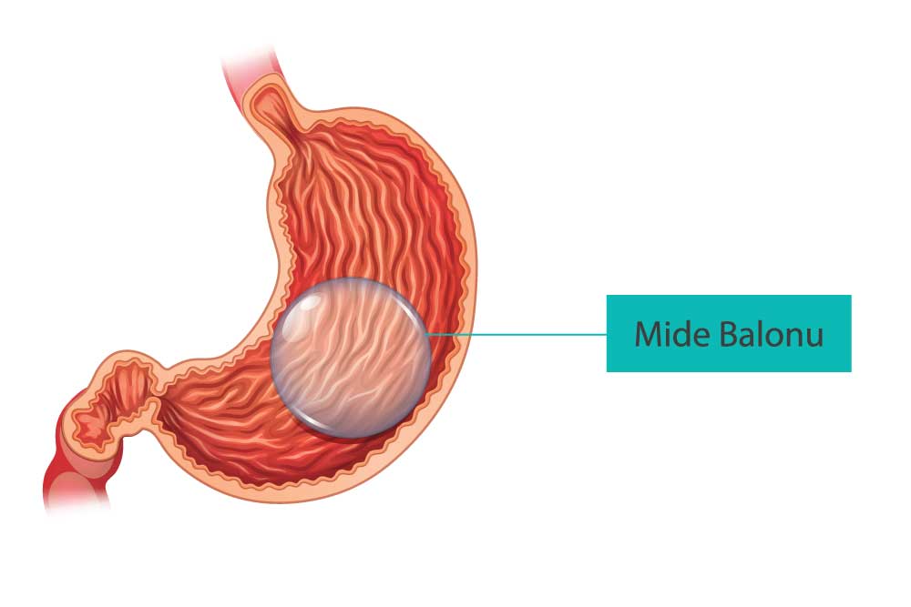 Mide Balonu