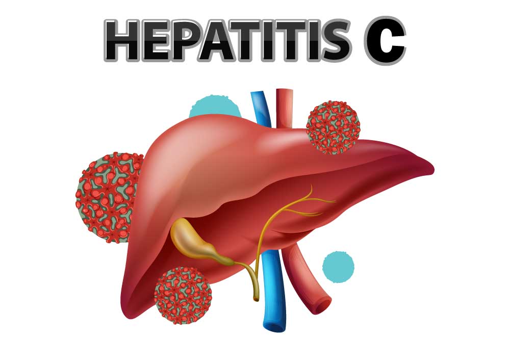 Hepatit c