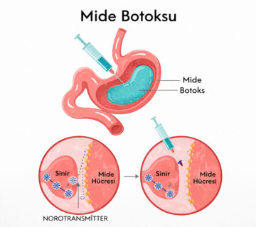 Mide botoksu