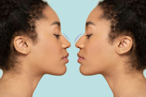 Burun Estetiği(Rinoplasti)