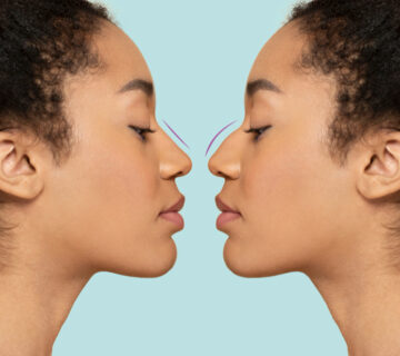 Burun Estetiği(Rinoplasti)